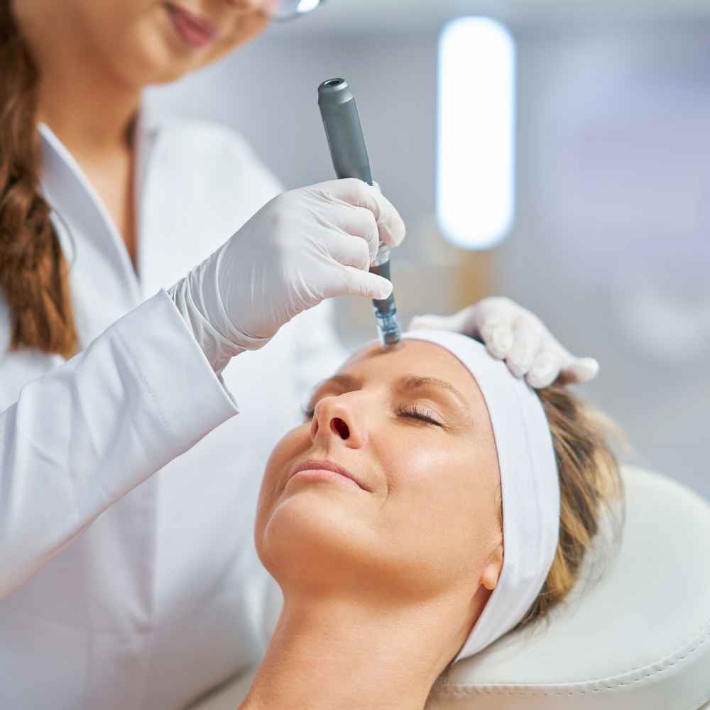 Microneedling coulsdon