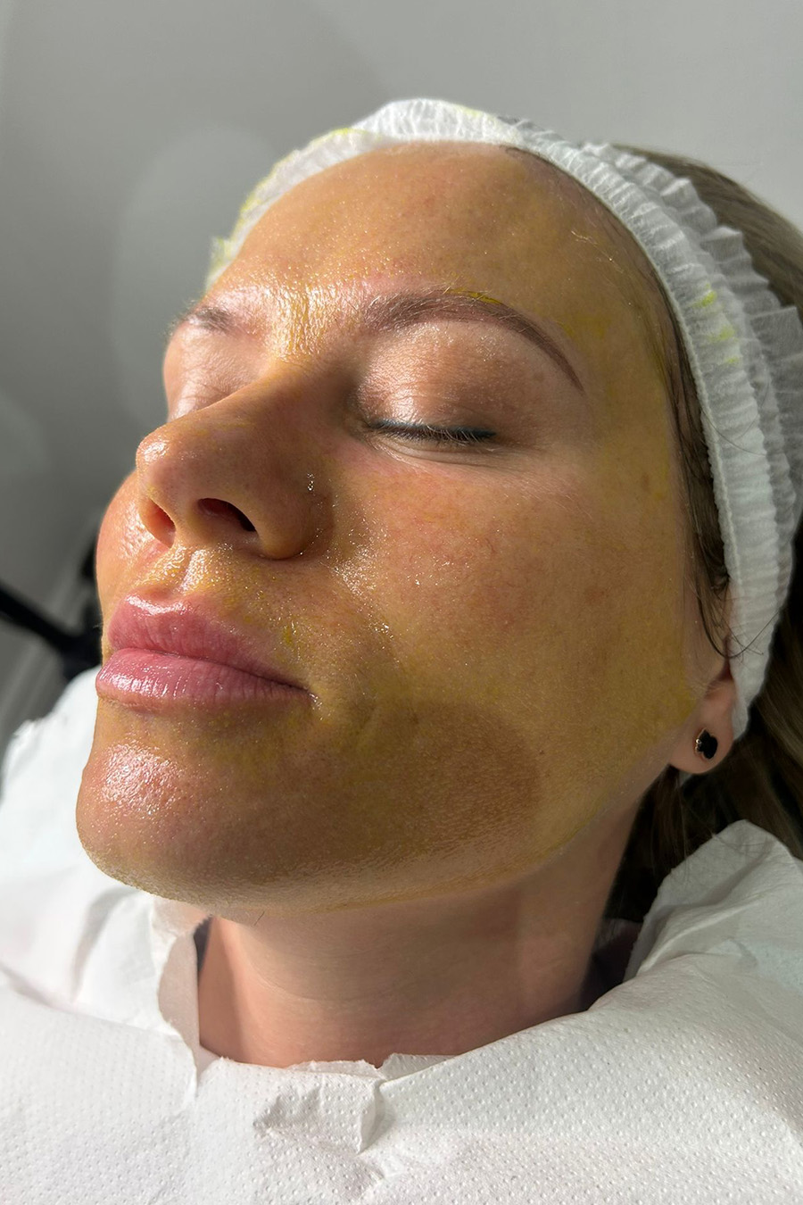 Chemical Peel