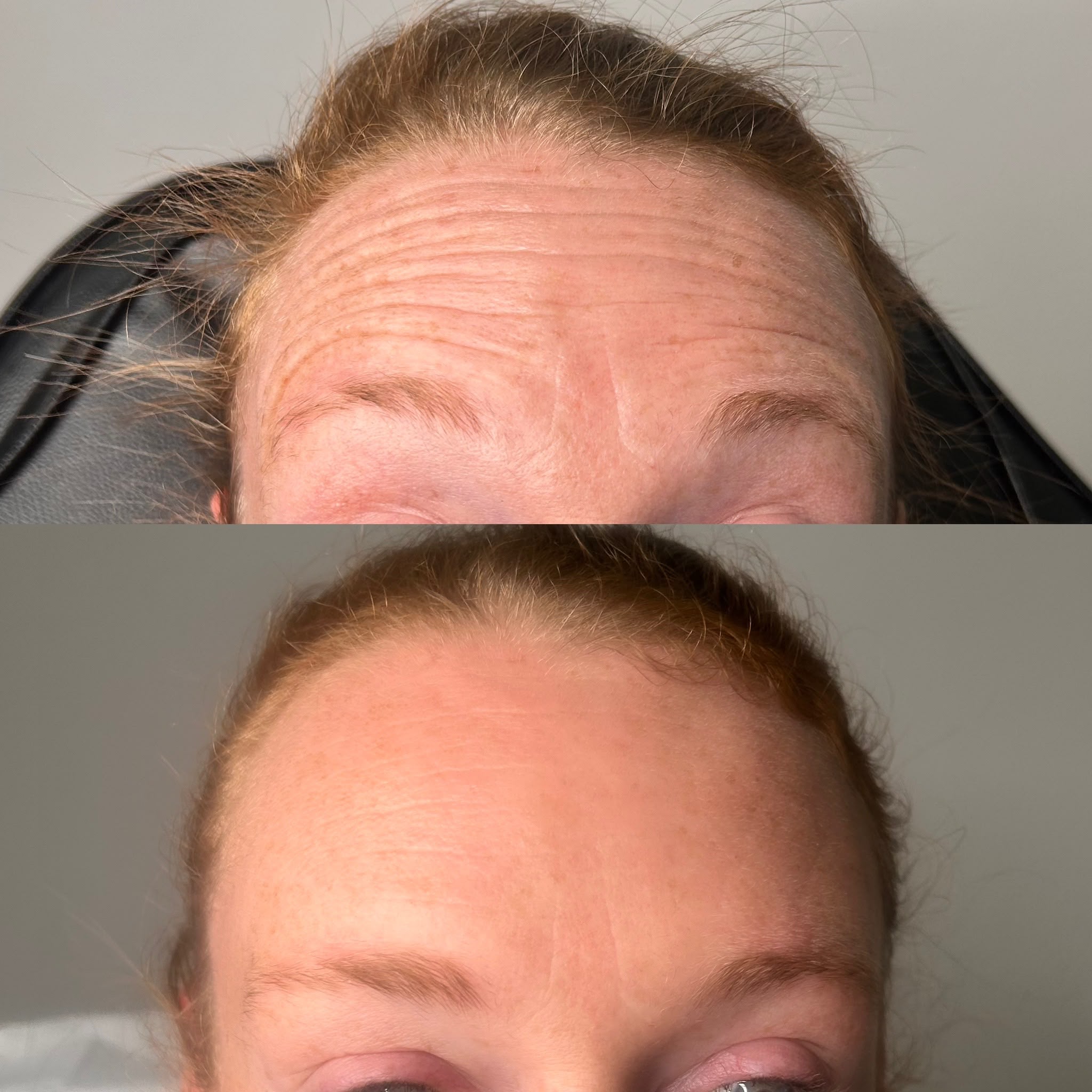 anti wrinkle before and after forehead