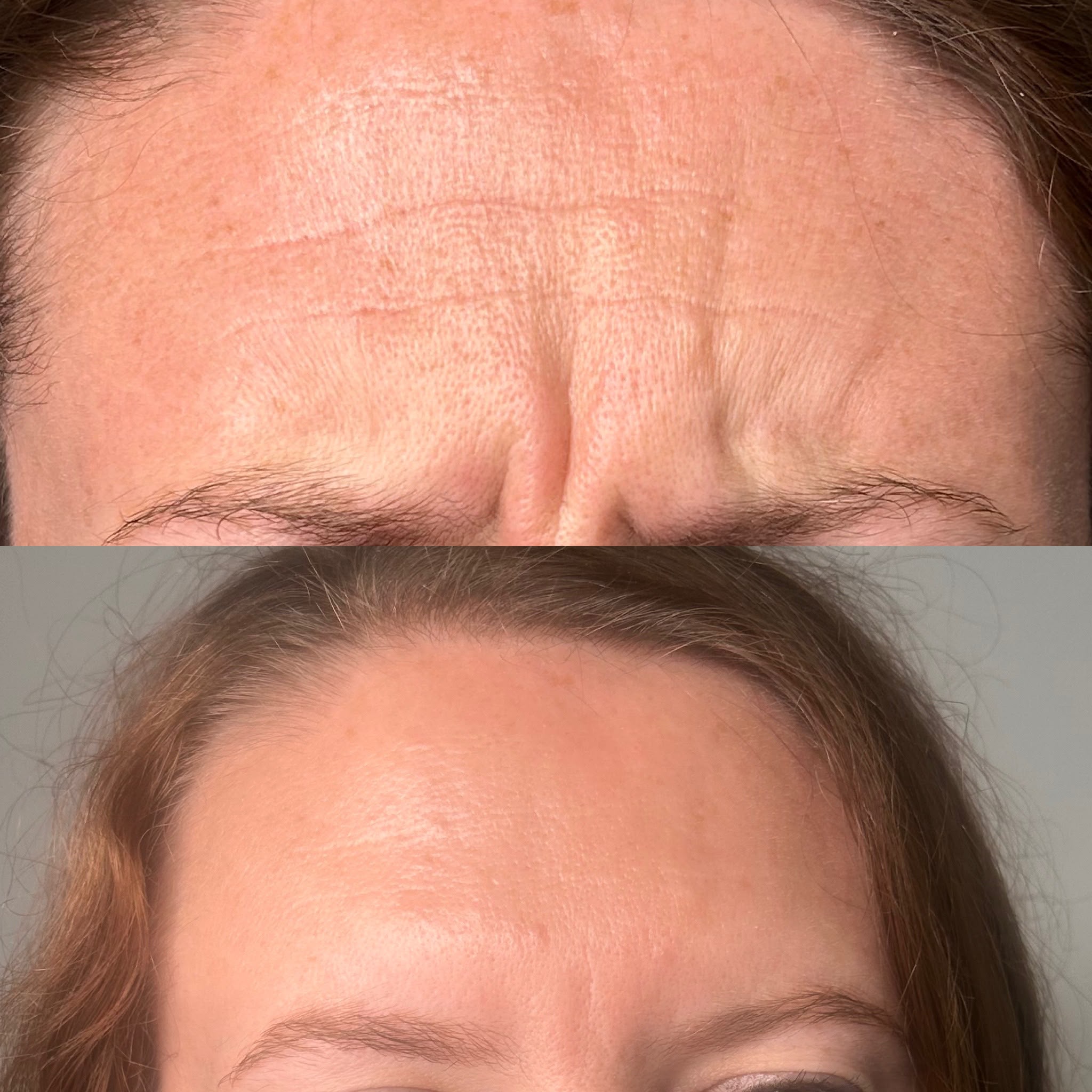 anti wrinkle before and after