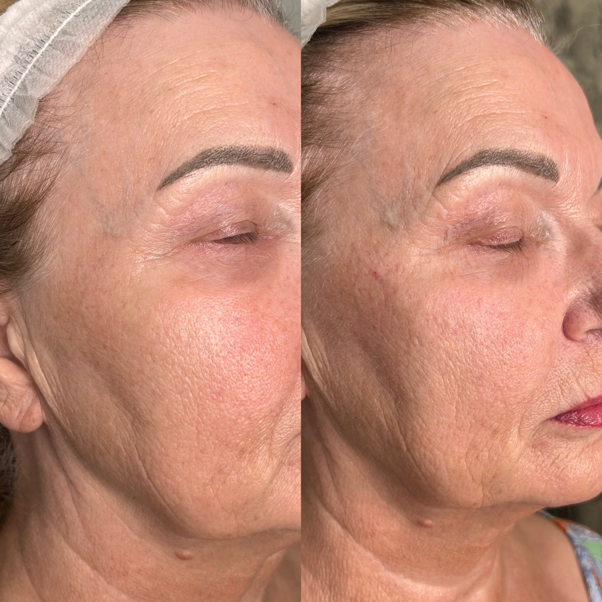 anti wrinkle before and after crows feet