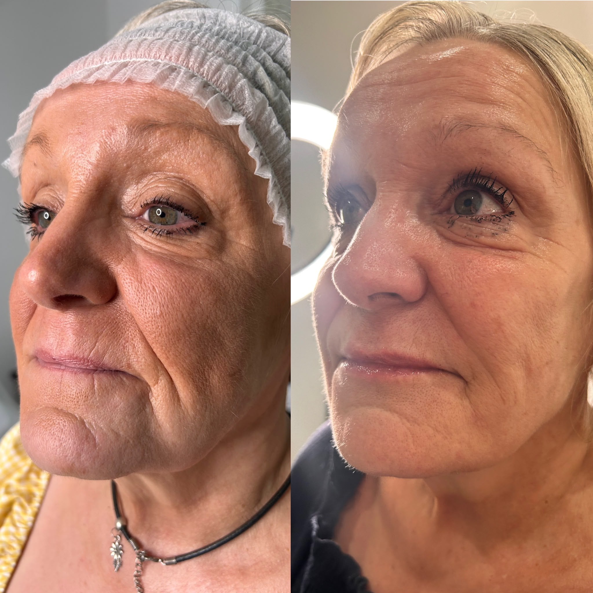 anti winkle before and after cheeks