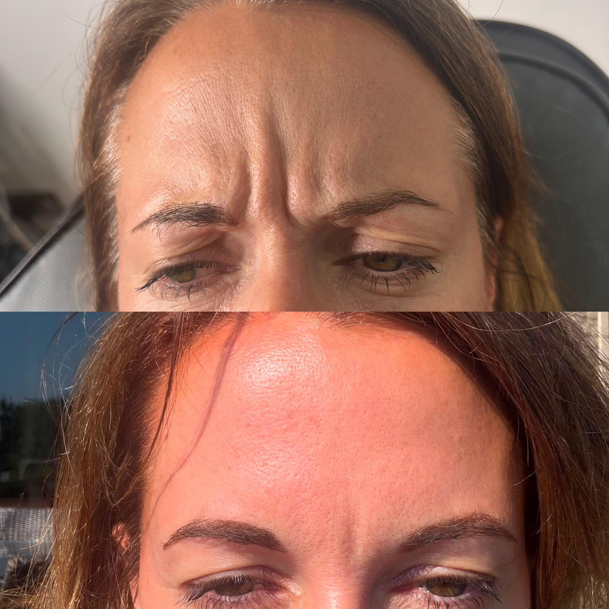 antiwrinkle forehead wrinkles before and after