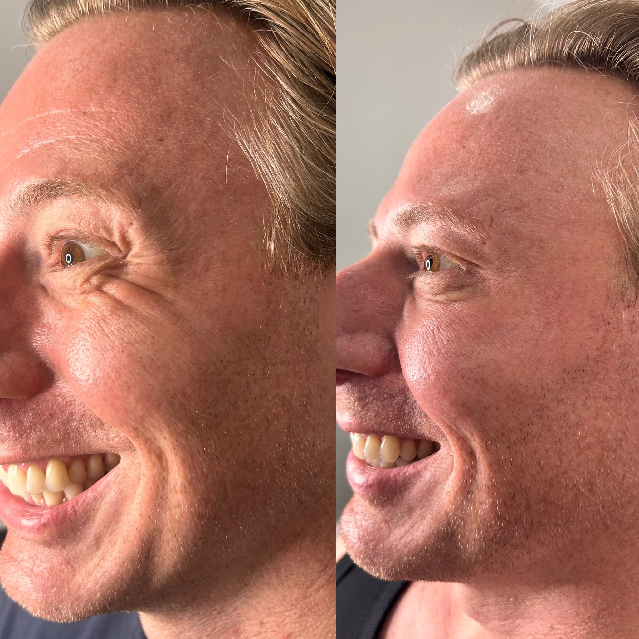 anti wrinkle before and after crows feet