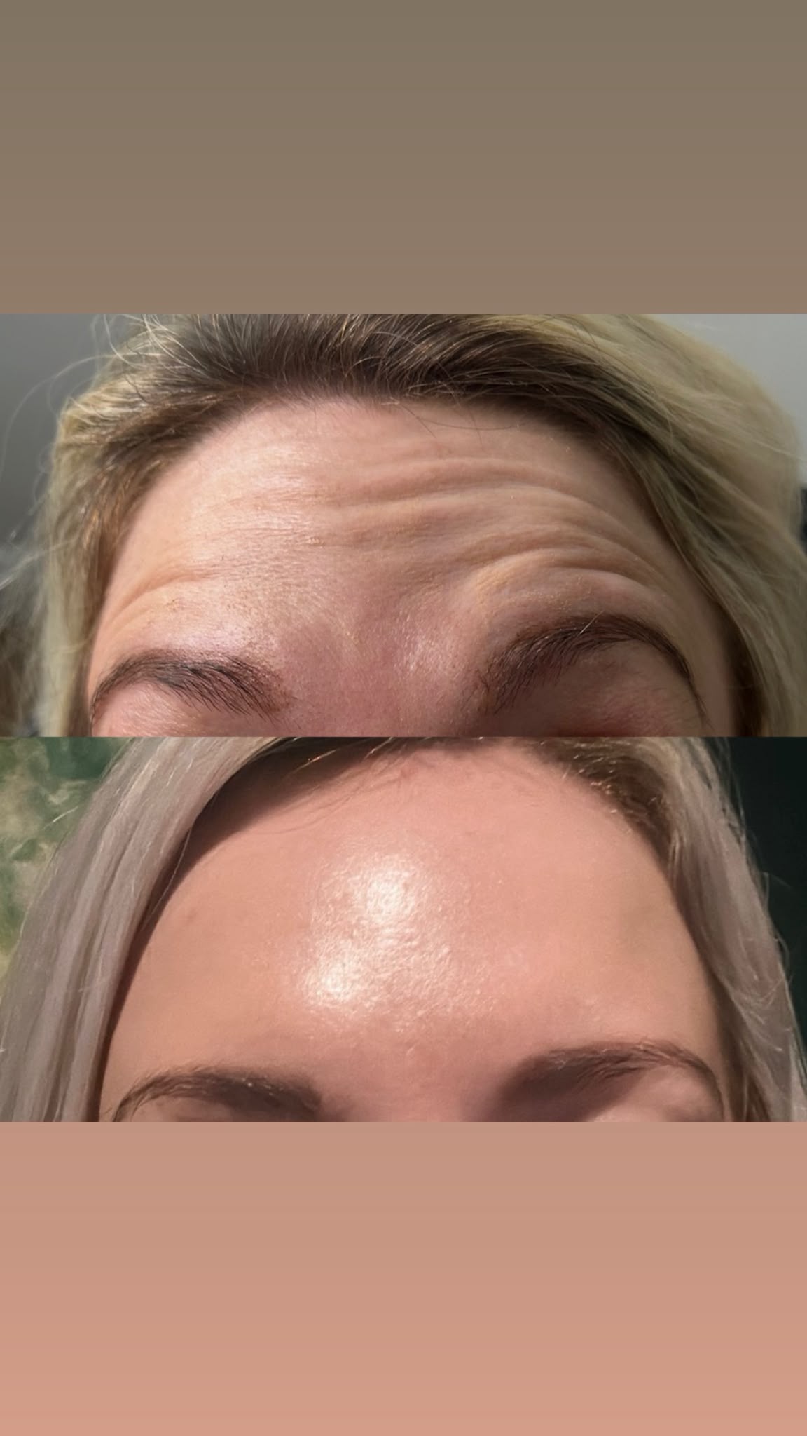 forehead antiwrinkle treatment before and after