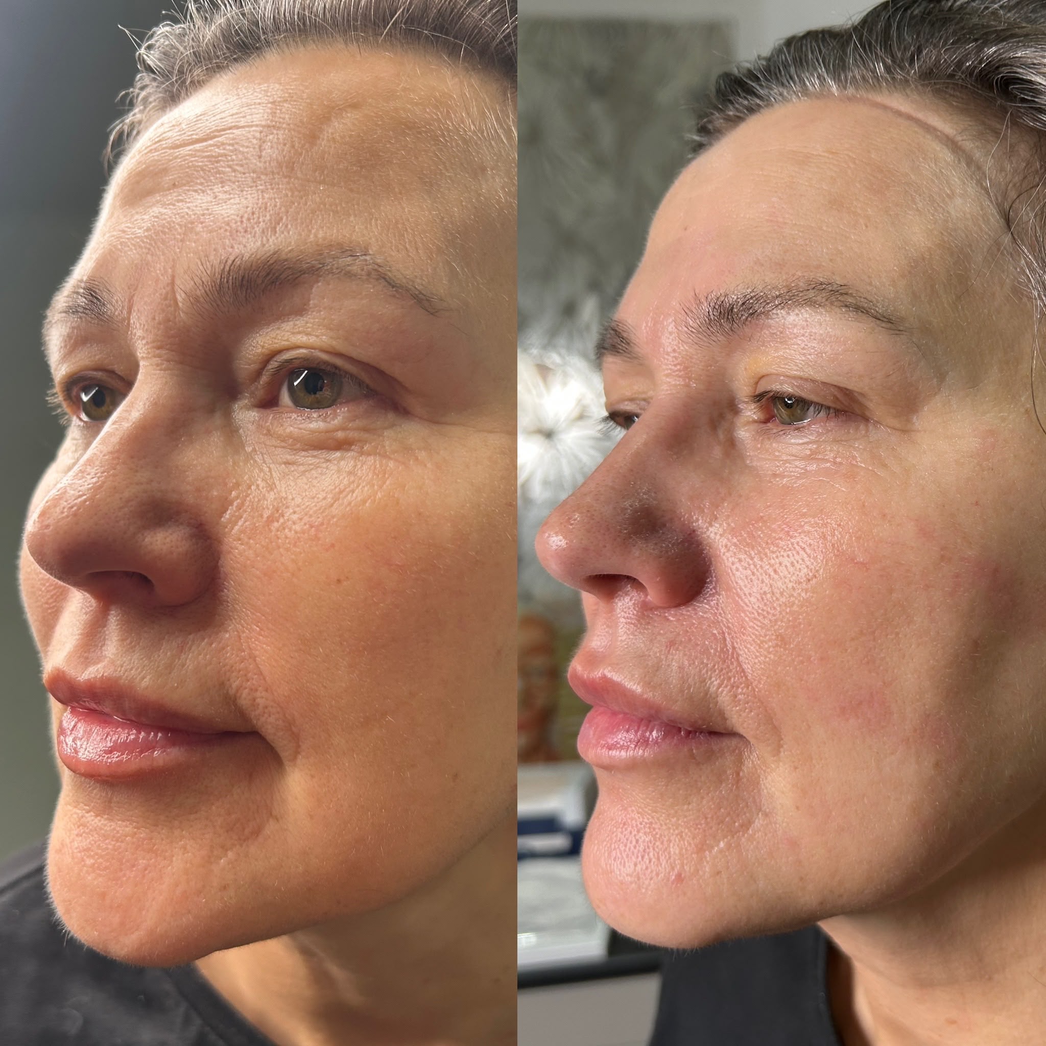 client anti wrinkle before and after