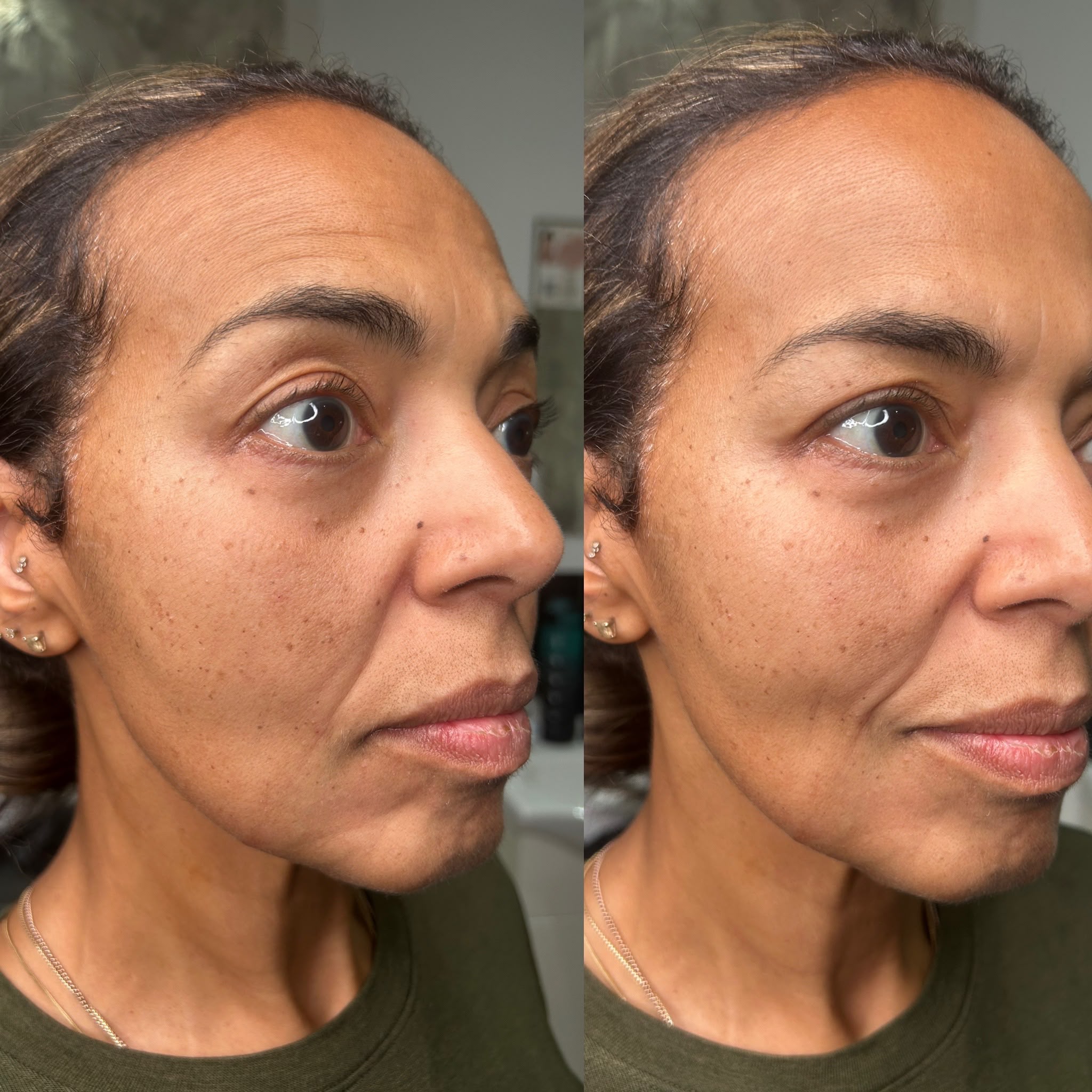 before an after for client with anti wrinkle treatment