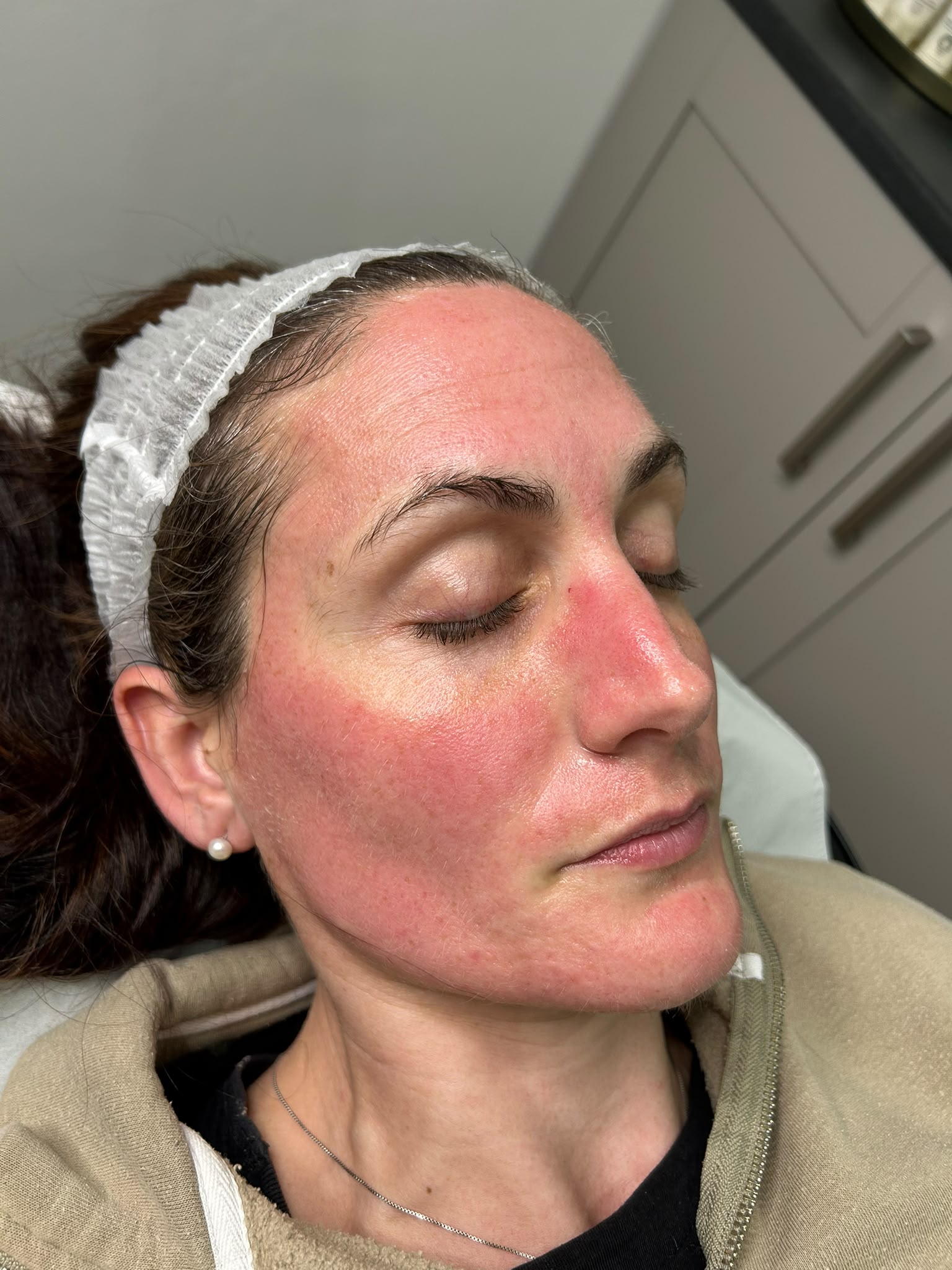 microneedling before and after #2