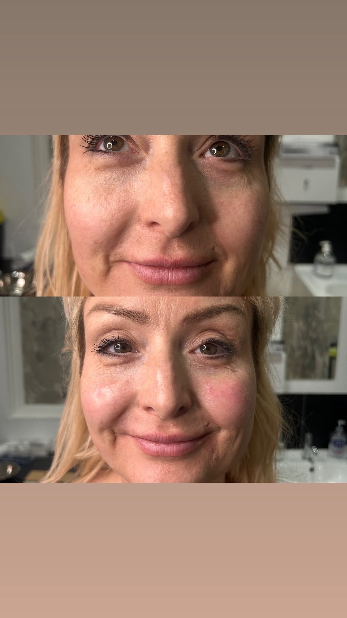 anti wrinkle before and after facial