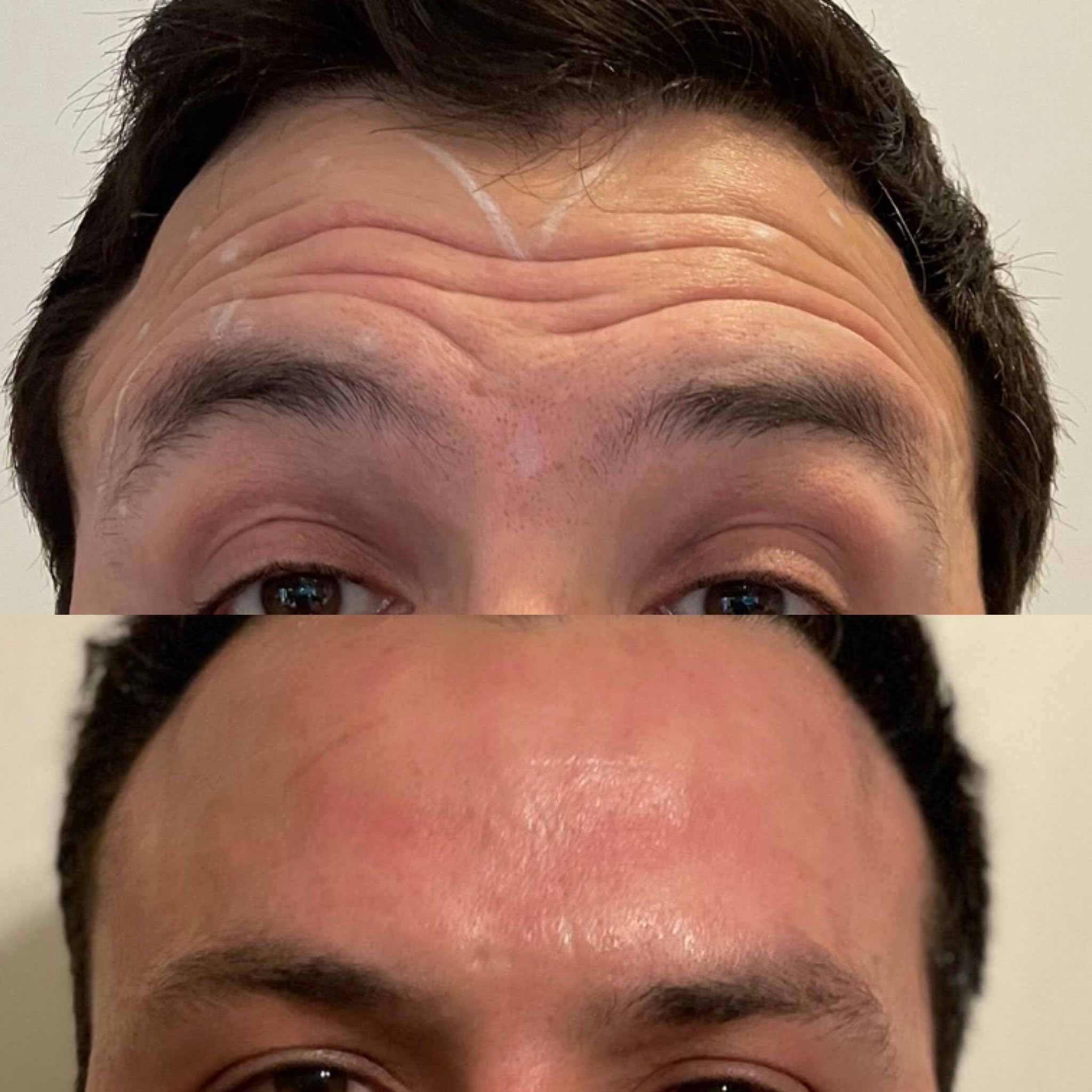 anti wrinkle before and after
