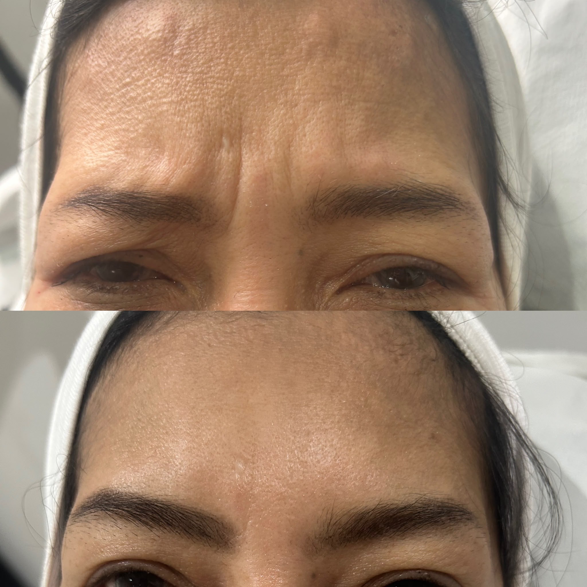 anti wrinkle before and after treatment