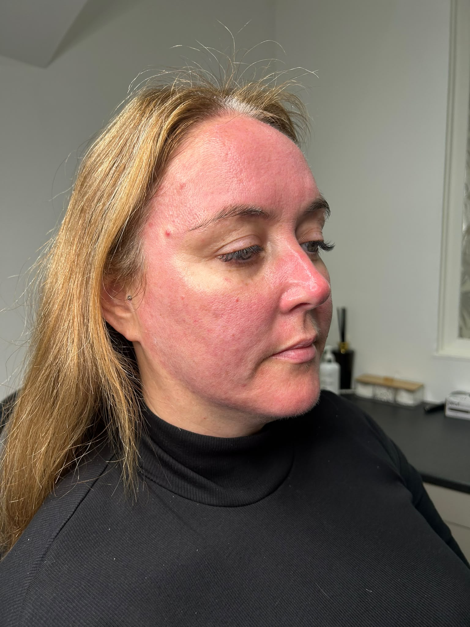 microneedling before and after