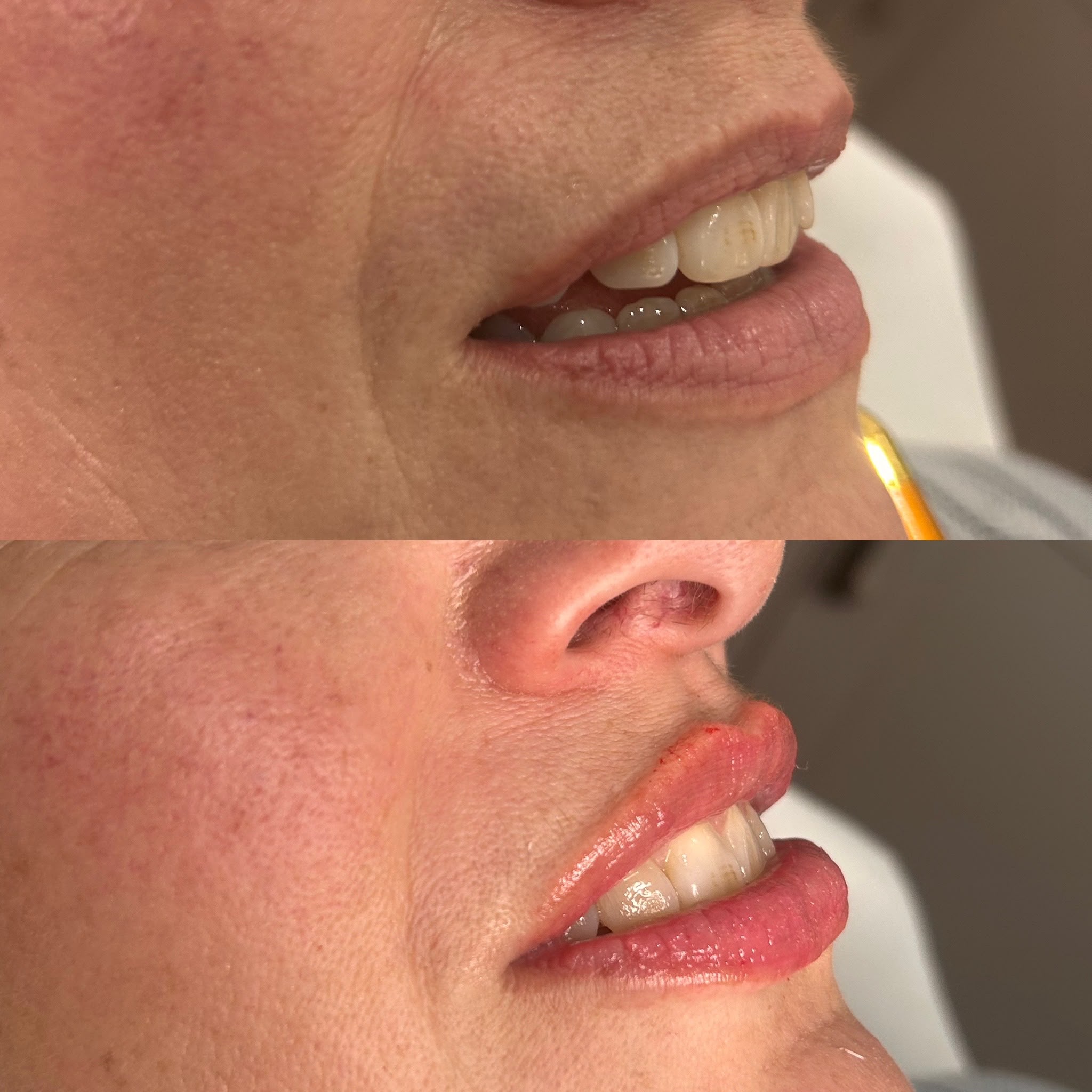 lip filler before and after #2