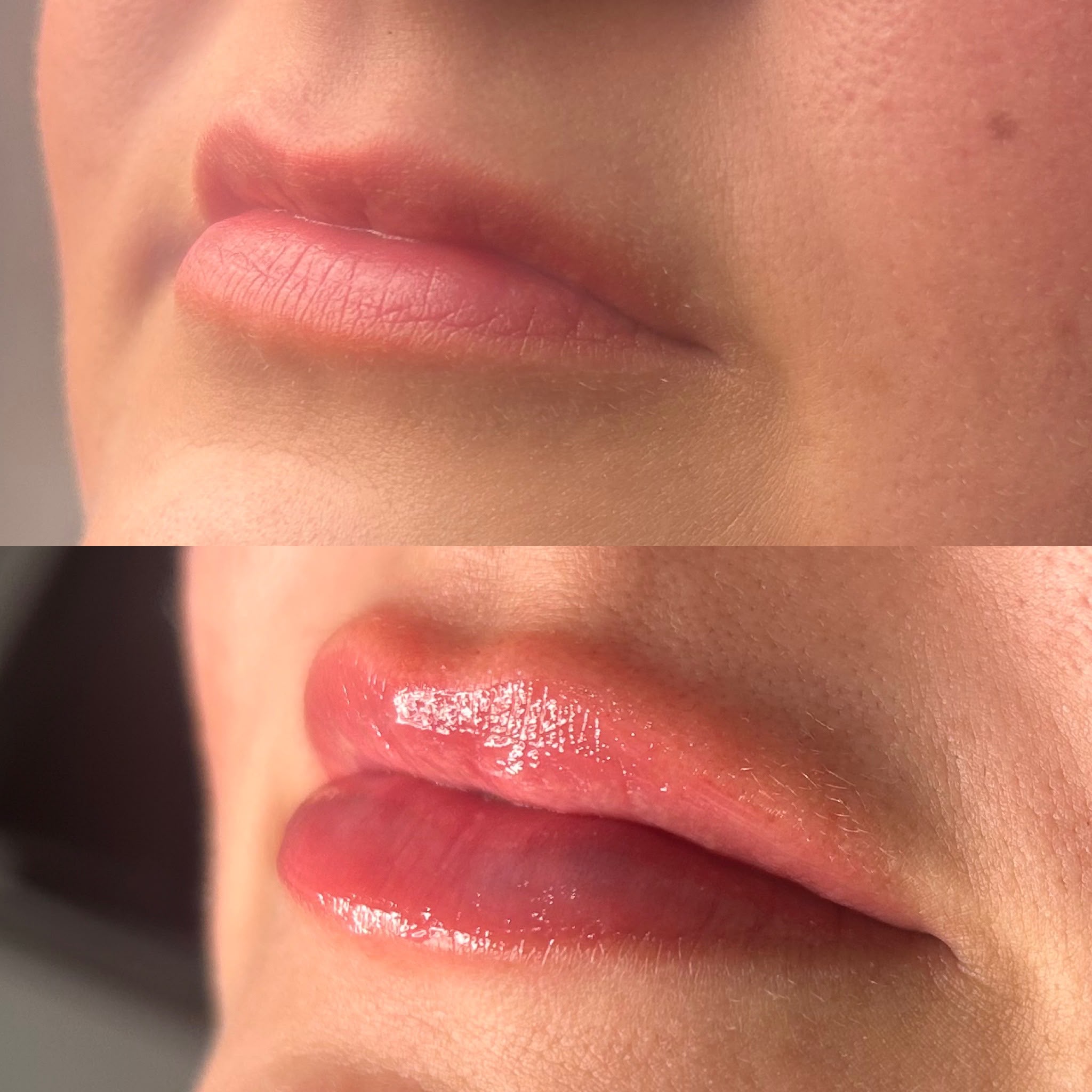 lip filler before and after 3