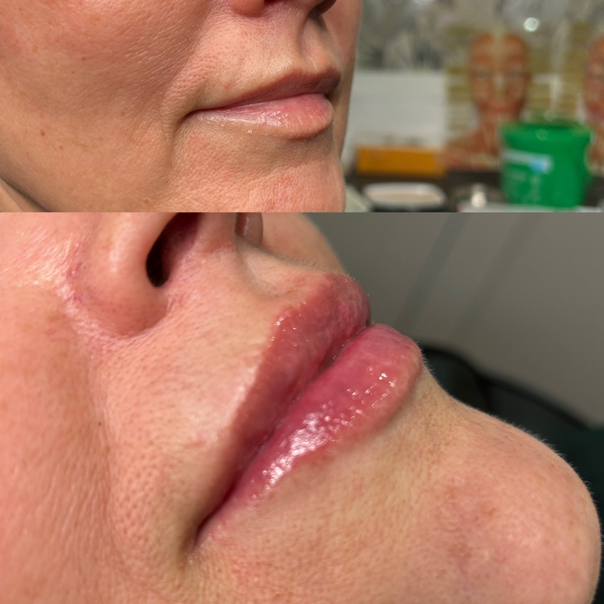 lip filler before and after 4