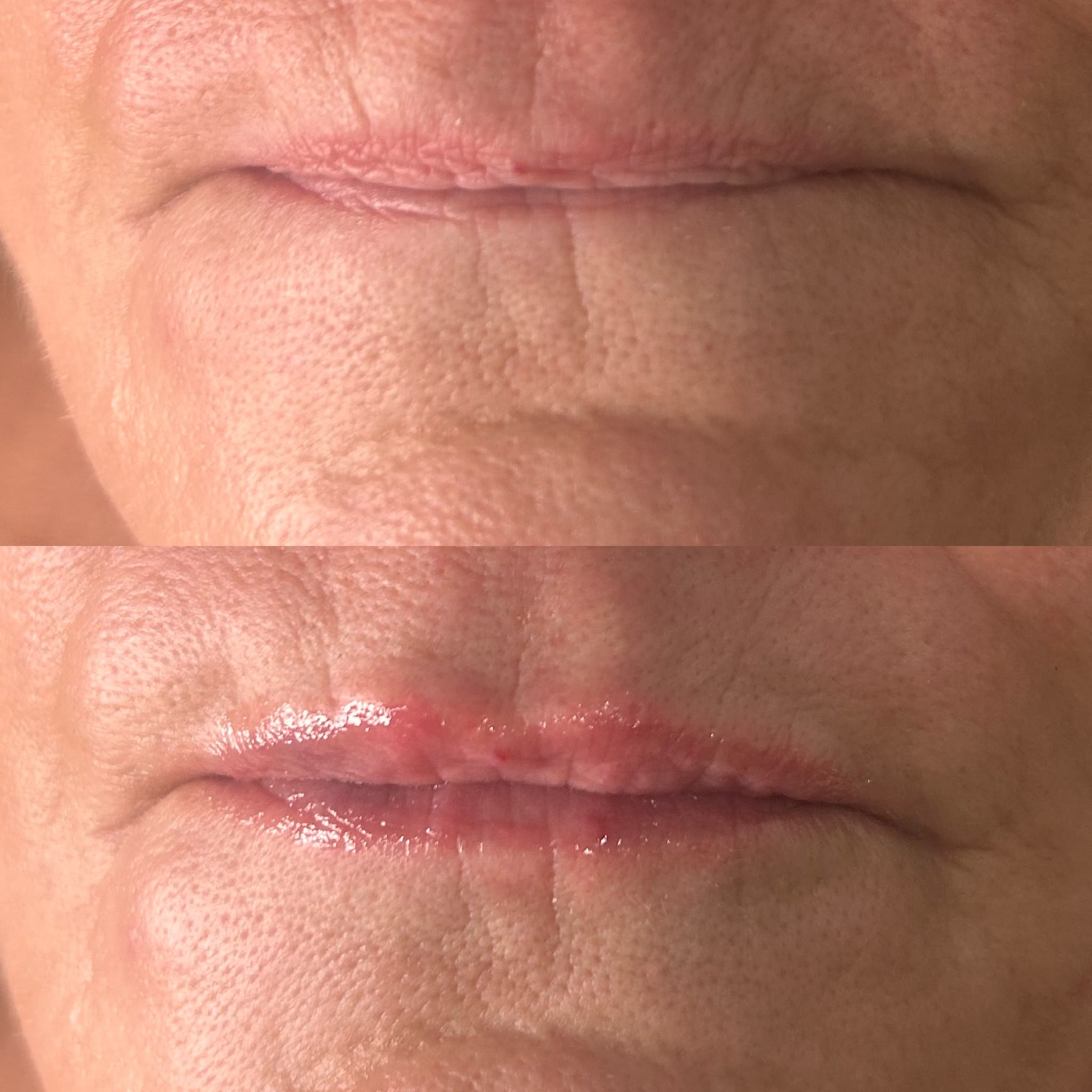 lip filler before and after